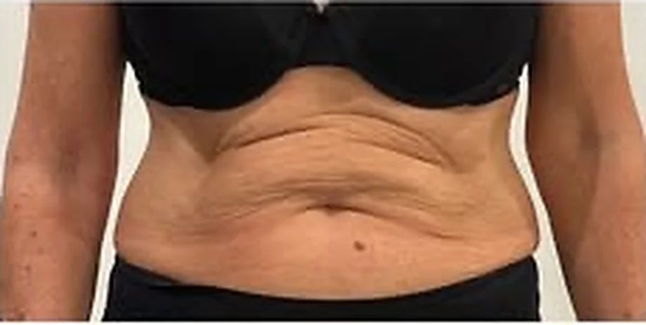 Abdomen de una paciente antes del tratamiento con endoláser