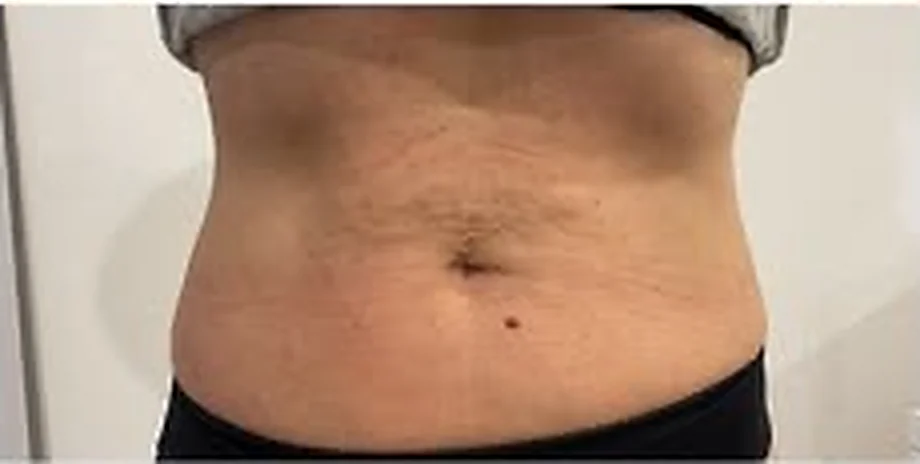 El mismo abdomen después del tratamiento con endoláser, con la piel más firme